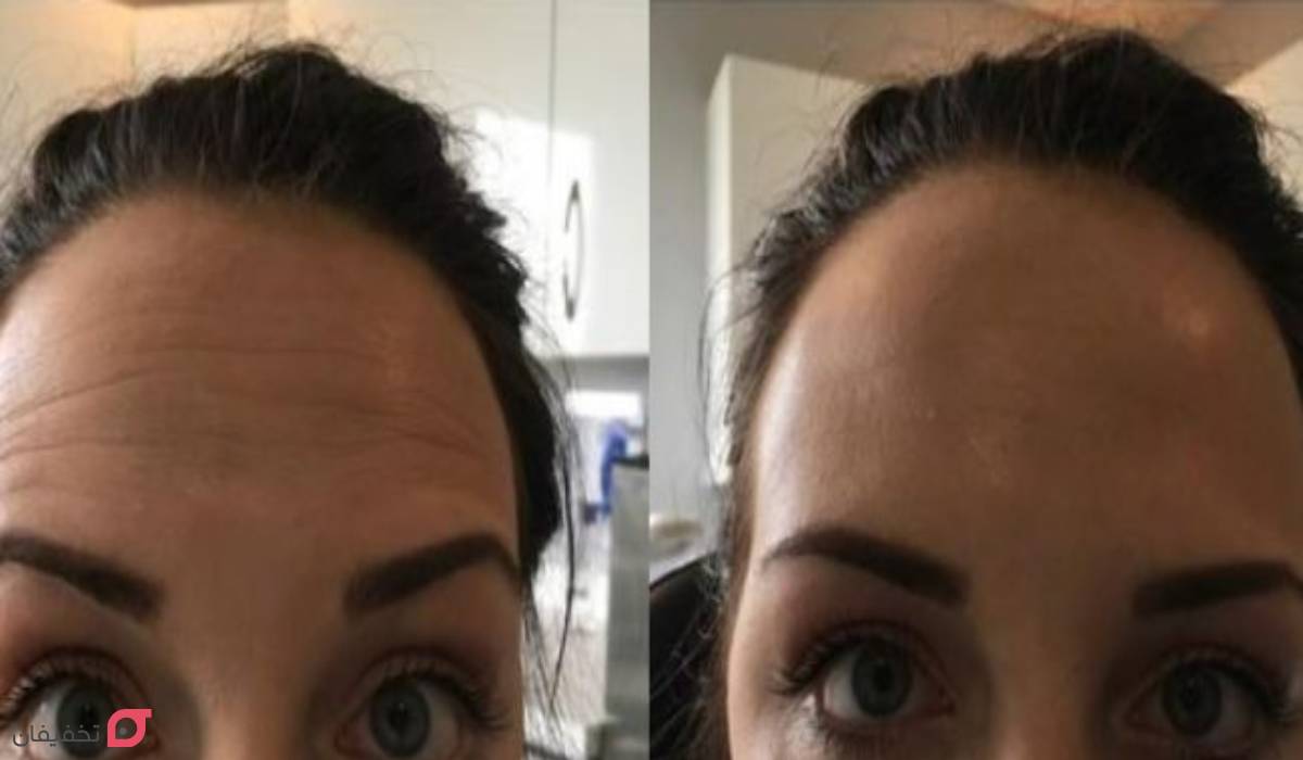 بوتاکس صورت قبل و بعد