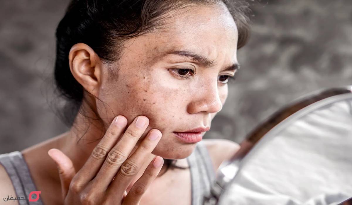 از بین بردن لک صورت با زردچوبه