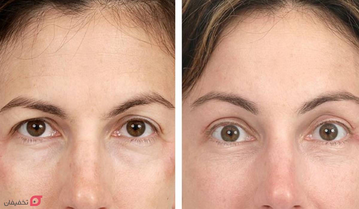 لیفت ابرو چیست | ماندگاری و انواع | عوارض و مزایا | عکس 4 لیفت ابرو چگونه انجام می شود؟