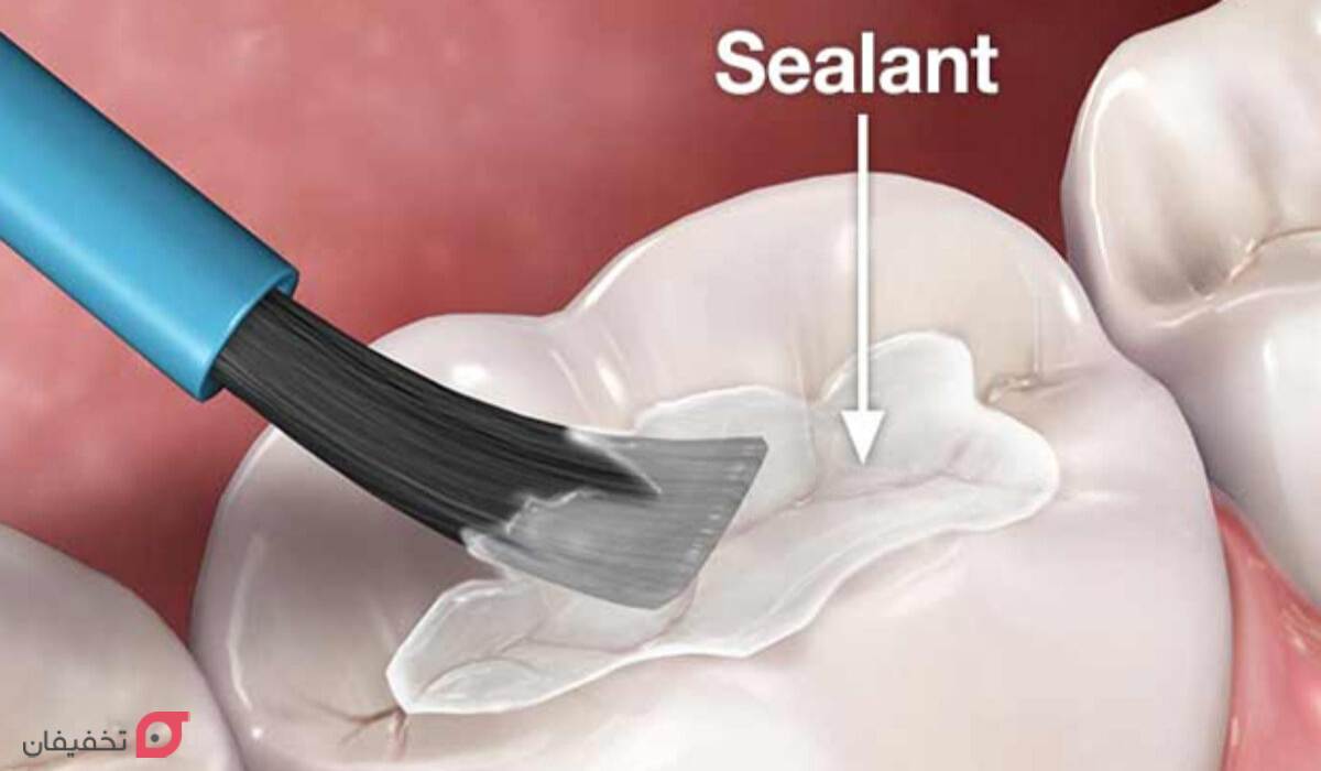 فیشور سیلانت دندان چیست | مزایا و عوارض شیاربندی دندان کودکان 3 جنس فیشور سیلانت