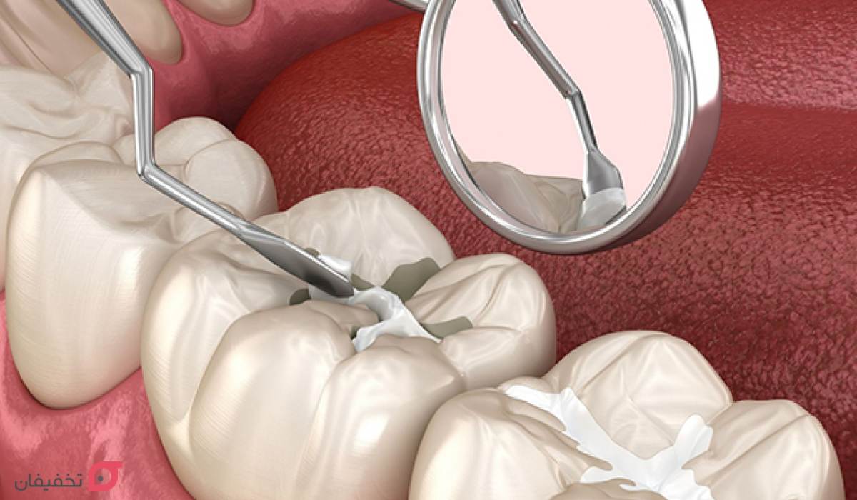 فیشور سیلانت دندان چیست | مزایا و عوارض شیاربندی دندان کودکان 4 فیشور سیلانت