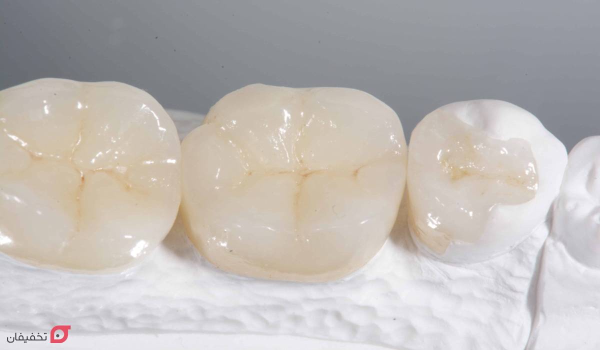 ترمیم دندان چیست | بهترین و جدیدترین روش ترمیم | مراحل انجام 9 ترمیم دندان