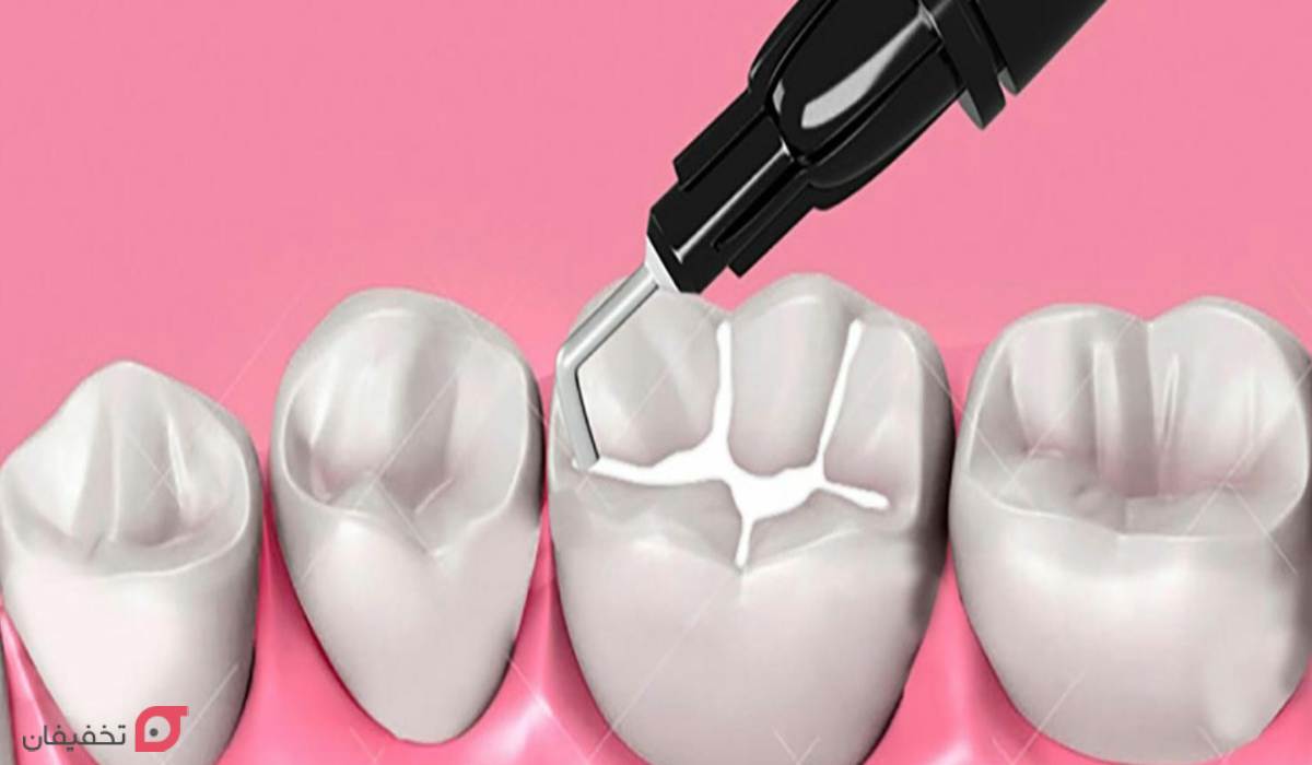 فیشور سیلانت دندان چیست | مزایا و عوارض شیاربندی دندان کودکان 12 هزینه فیشور سیلانت دندان