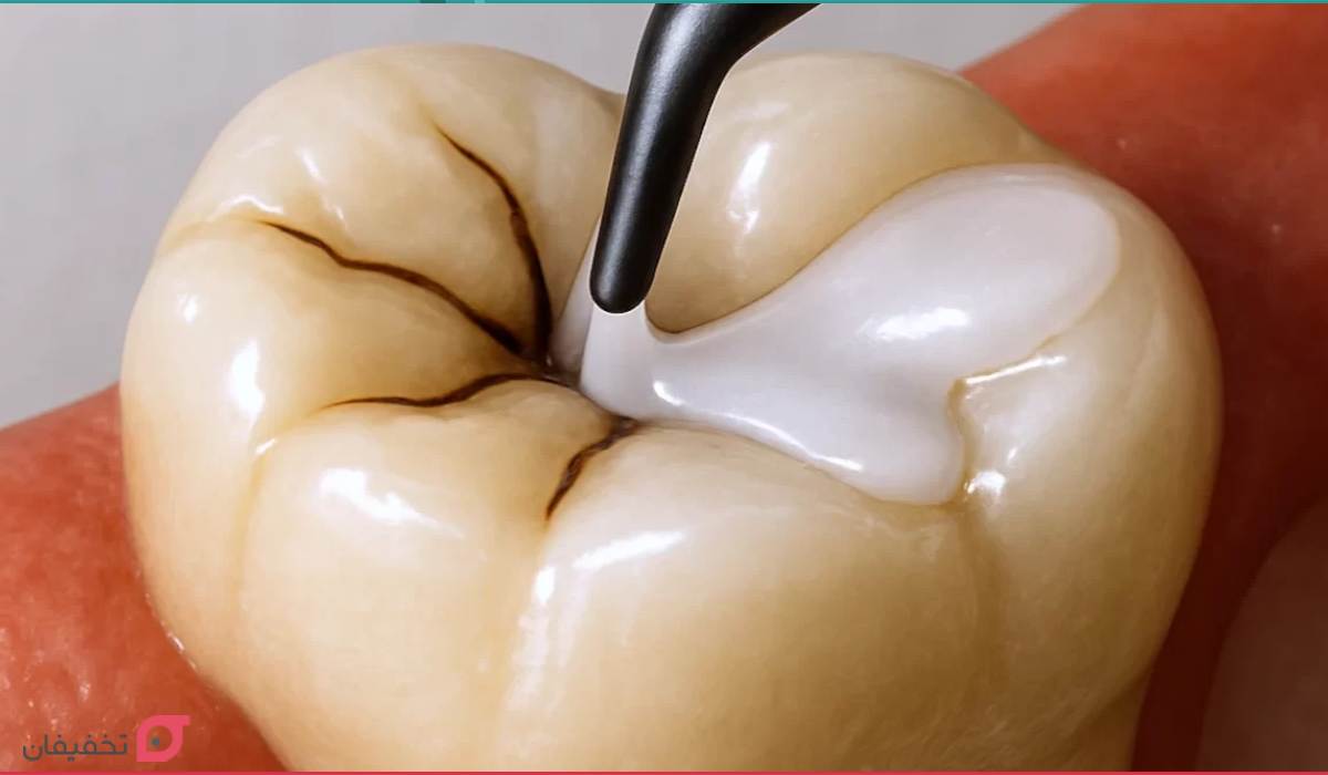 فیشور سیلانت دندان چیست | مزایا و عوارض شیاربندی دندان کودکان 9 فیشور سیلانت کودکان