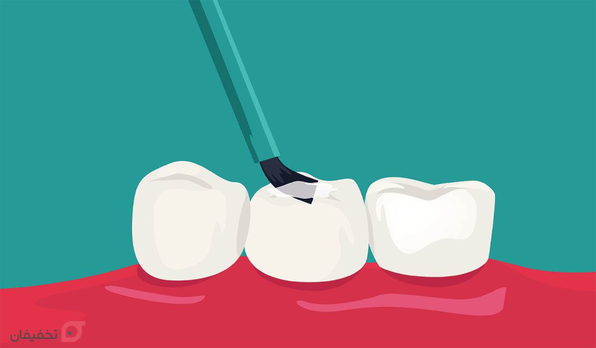 فیشور سیلانت دندان چیست | مزایا و عوارض شیاربندی دندان کودکان 6 شیار بندی دندان