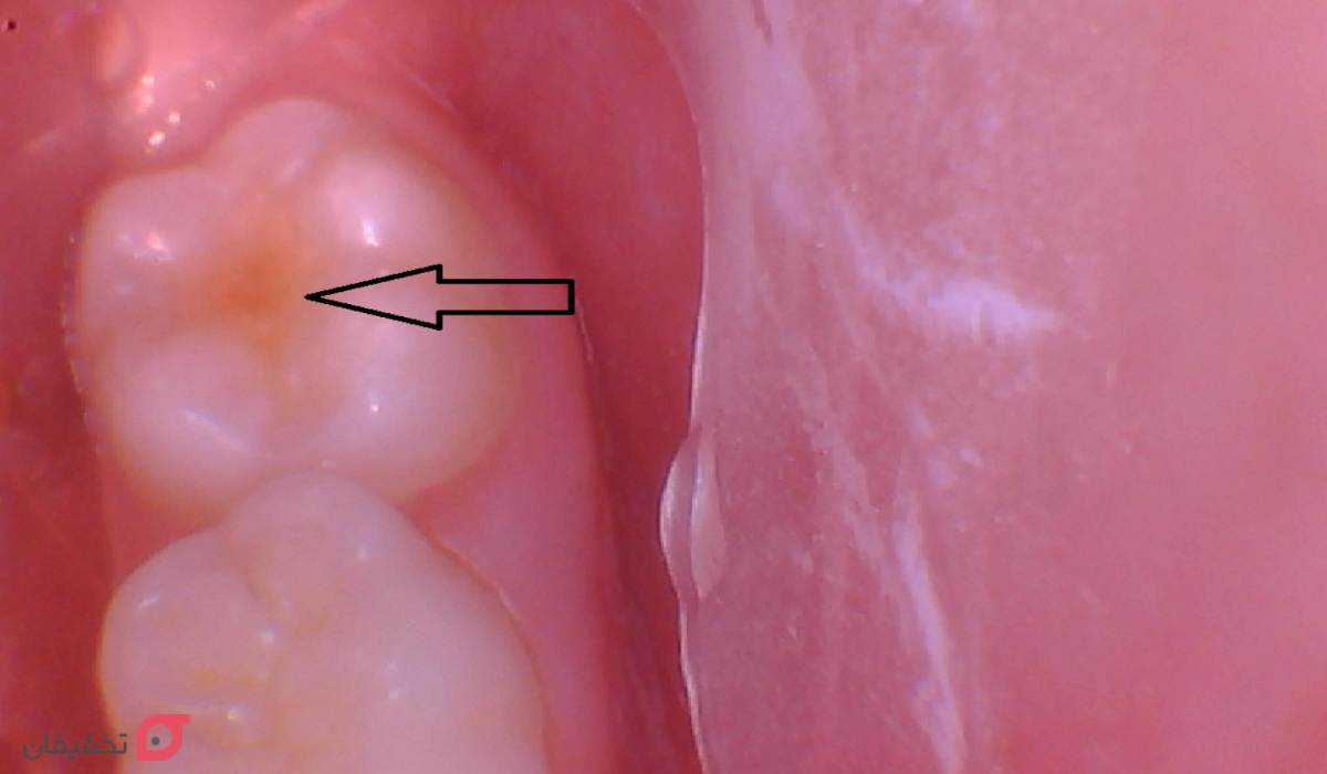 فیشور سیلانت دندان چیست | مزایا و عوارض شیاربندی دندان کودکان 11 شیارپوشی دندان