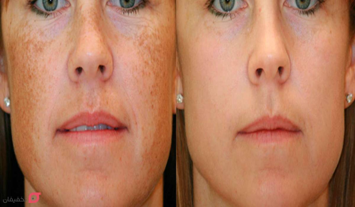 پلاسما جت چیست | روش کار | مزایا و عوارض | ماندگاری | عکس 7 عکس قبل و بعد پلاسما جت صورت