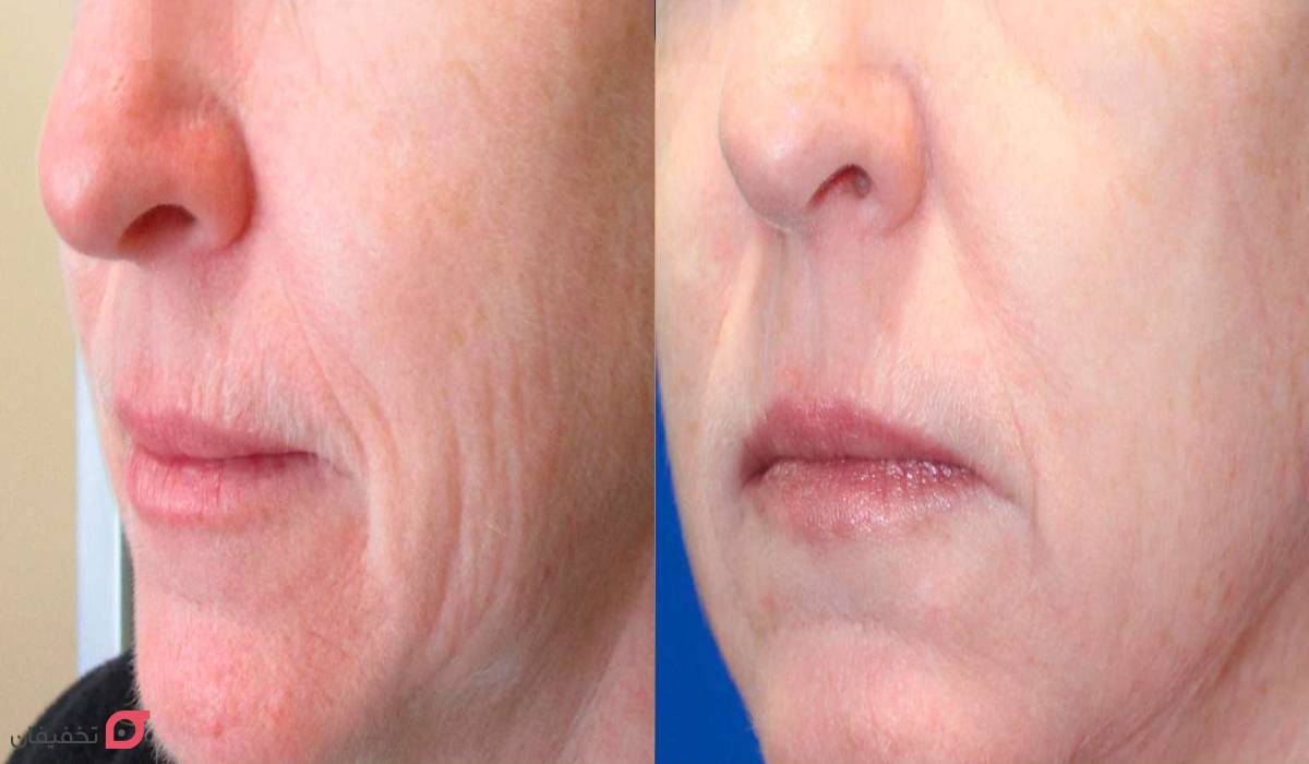 پلاسما جت چیست | روش کار | مزایا و عوارض | ماندگاری | عکس 5 عکس قبل و بعد پلاسما جت صورت