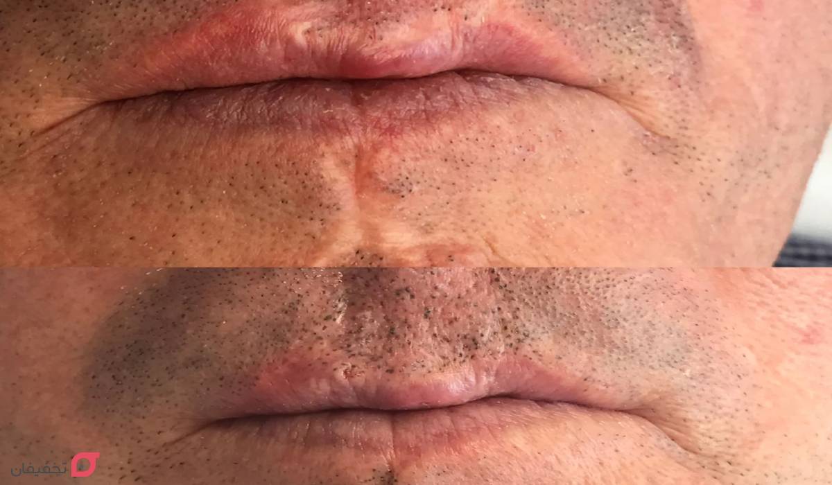 میکروپیگمنتیشن چیست | روش انجام + عکس | ماندگاری انواع آن 3 میکروپیگمنتیشن