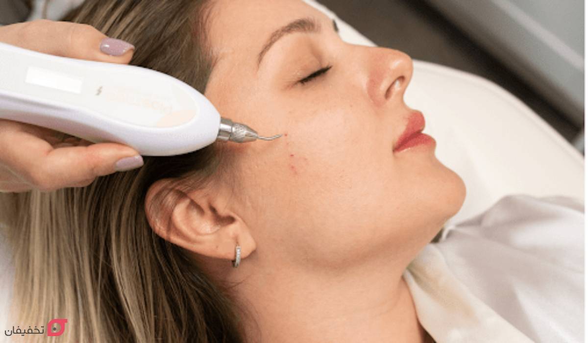 پلاسما جت چیست | روش کار | مزایا و عوارض | ماندگاری | عکس 3 پلاسما جت