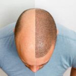 بهترین روش کاشت مو | جدیدترین روش بدون بانک مو، درد و جراحی 18 بهترین روش کاشت مو