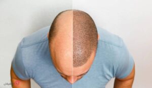 بهترین روش کاشت مو | جدیدترین روش بدون بانک مو، درد و جراحی