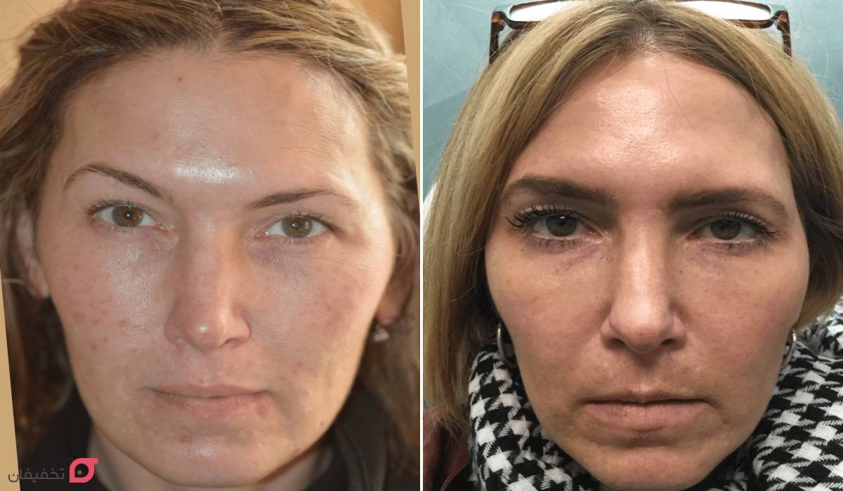 بوتاکس ابرو چیست | چگونه انجام می شود | چقدر ماندگاری دارد؟ 7 عکس قبل و بعد بوتاکس ابرو