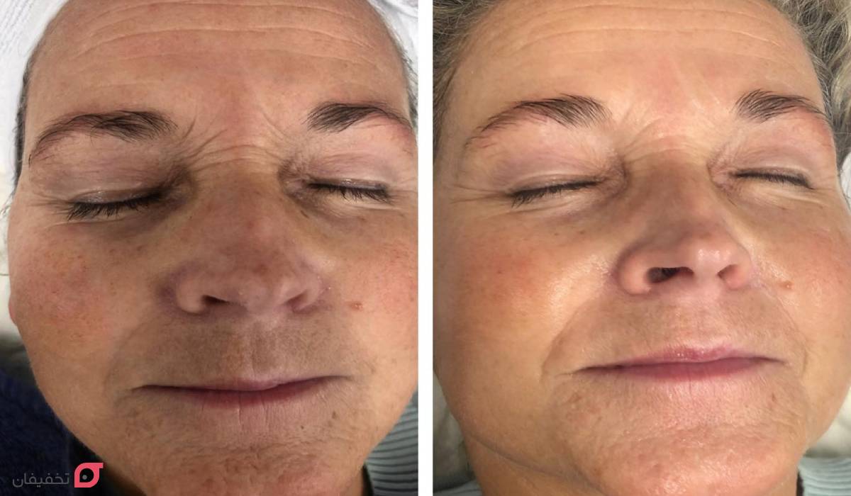 مزوتراپی صورت چیست | مدت اثر | فواید و عوارض | عکس نقاط تزریق 7 عکس قبل و بعد مزوتراپی صورت
