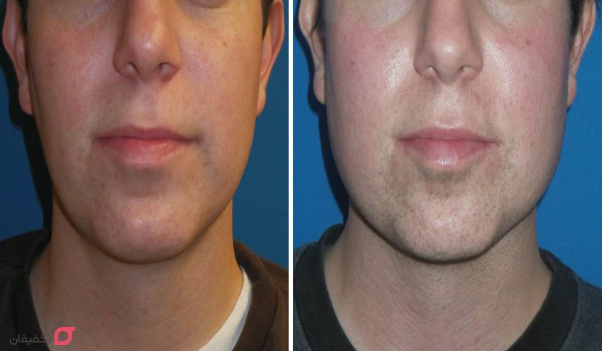 زاویه سازی فک | بهترین و سریعترین روش ساخت زاویه فک در خانه 3 زاویه سازی فک