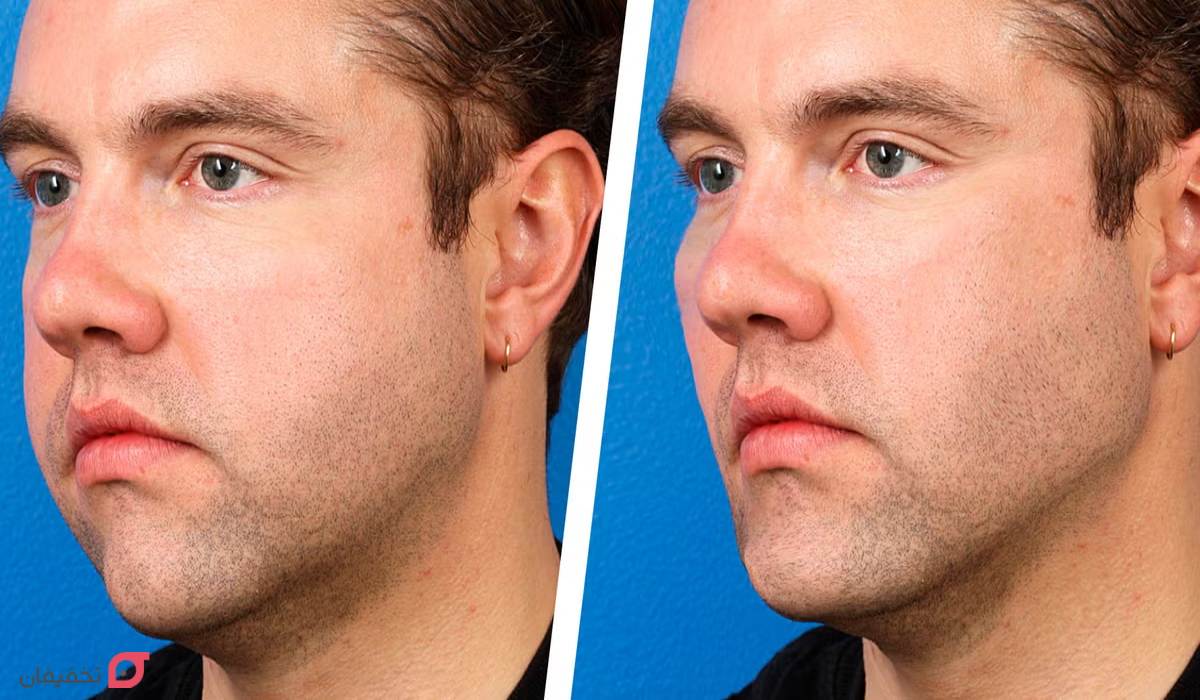 زاویه سازی فک | بهترین و سریعترین روش ساخت زاویه فک در خانه 6 زاویه سازی فک