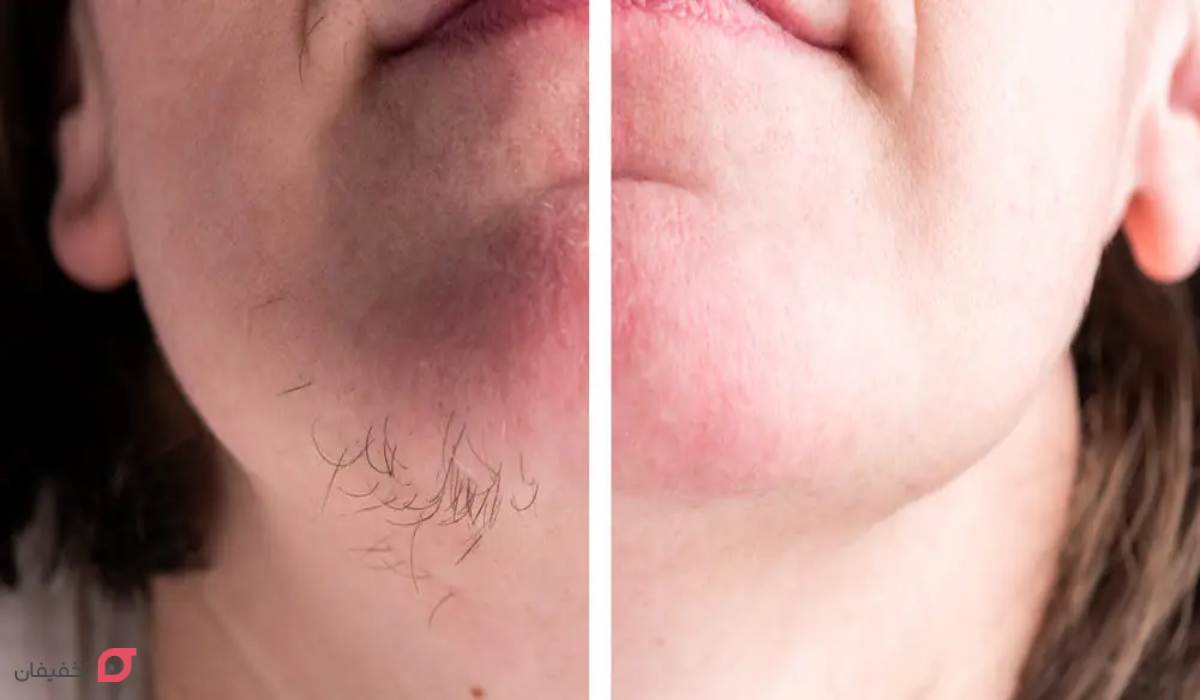 موهای زائد چانه در زنان نشانه چیست | 10 درمان خانگی و گیاهی 7 موهای زائد چانه