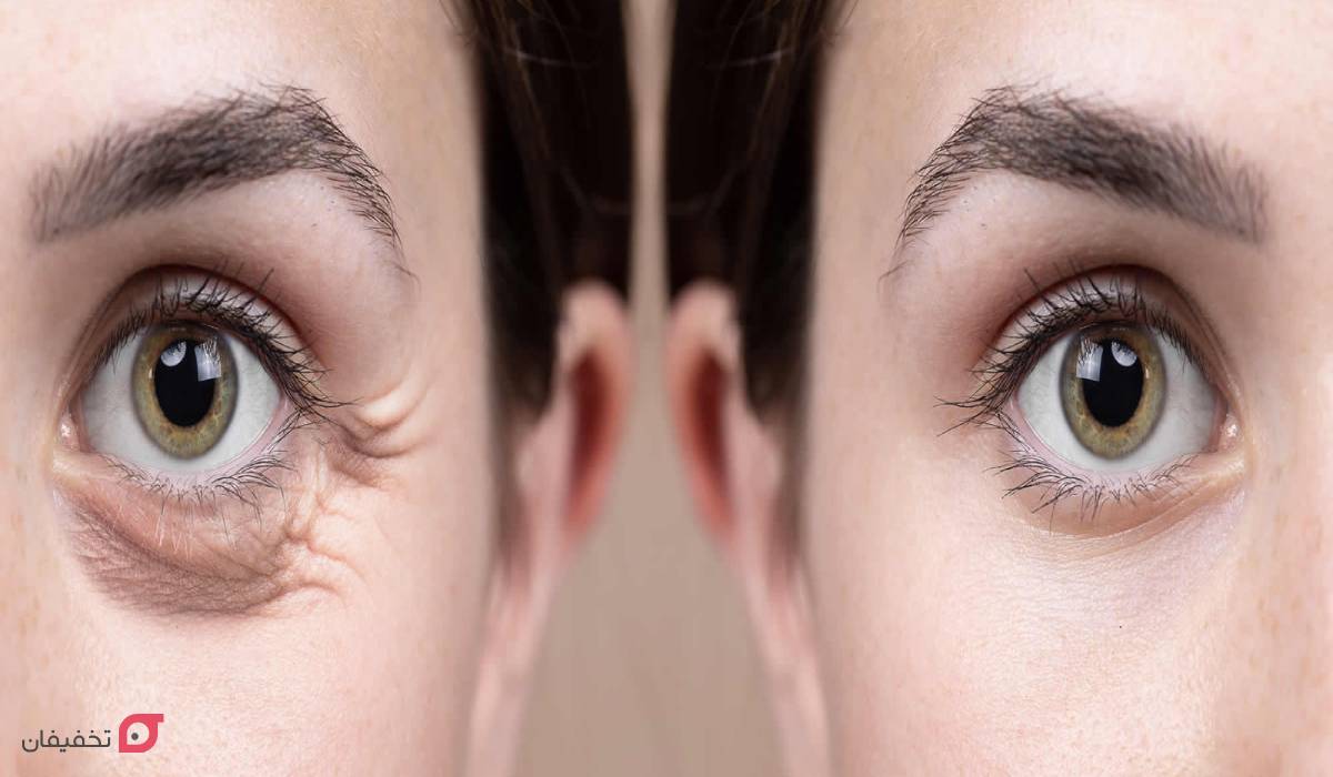 مزوتراپی زیر چشم چند جلسه است؟