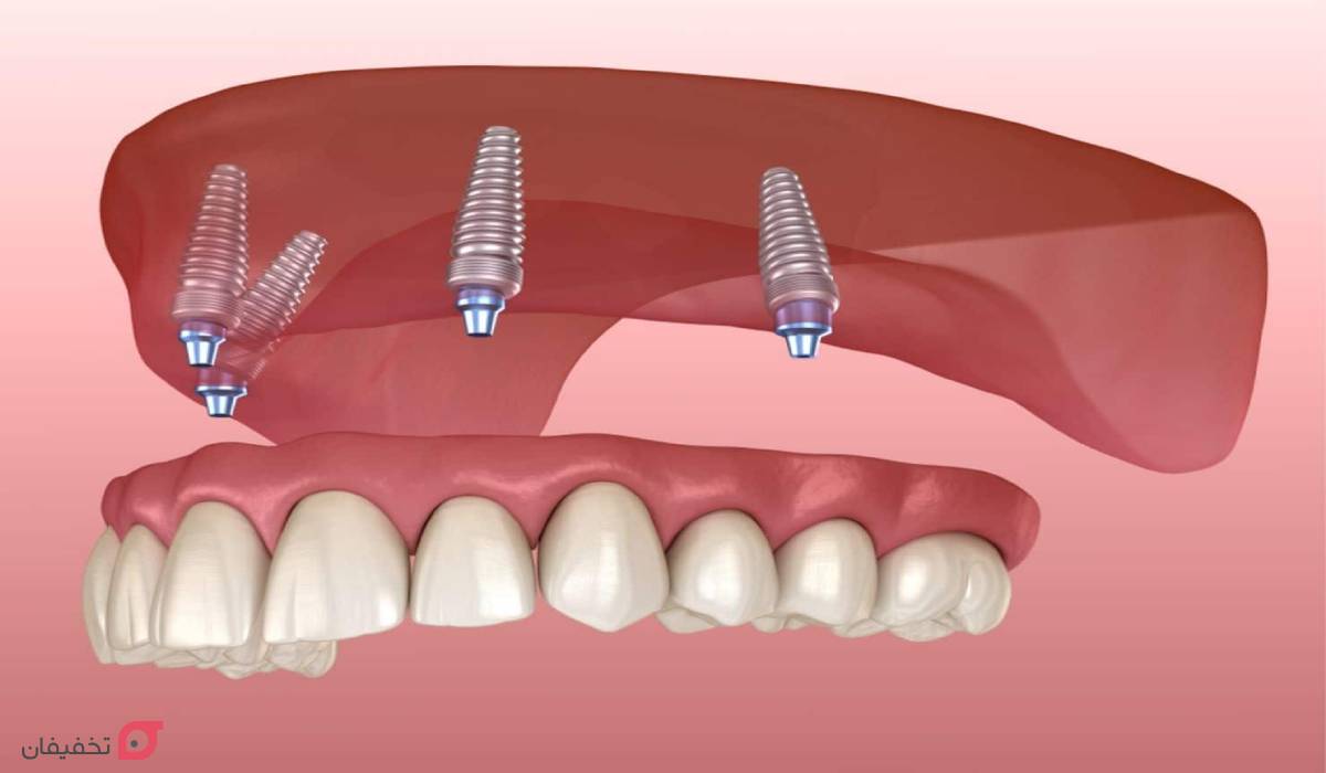 ایمپلنت دندان چیست | چند مرحله و روش دارد | چقدر طول می کشد 11 ایمپلنت دندان