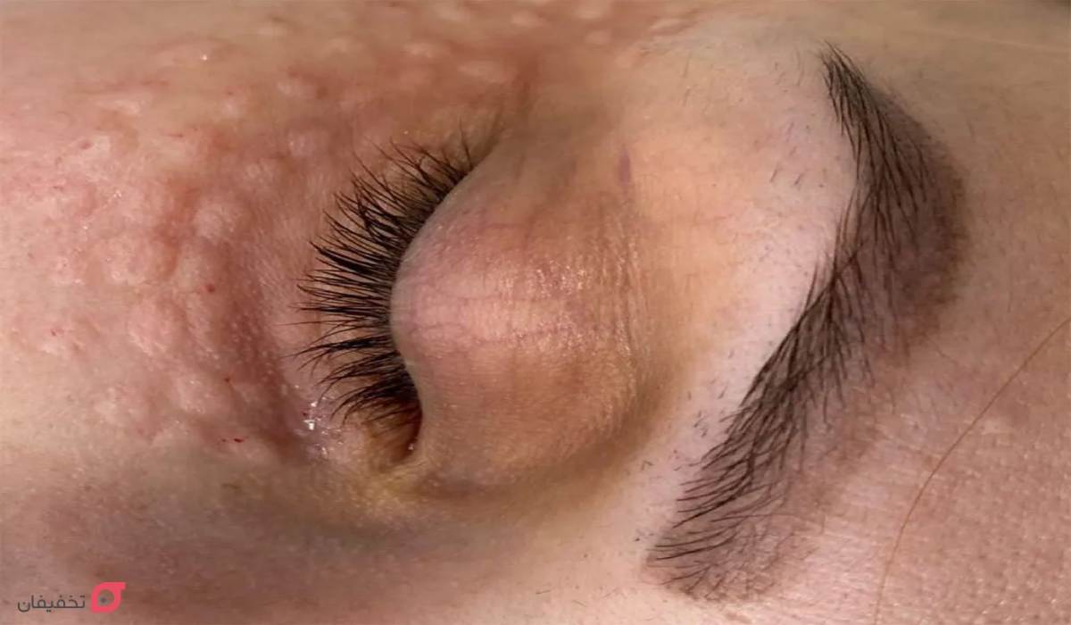 مزوتراپی زیر چشم | مزایا و عوارض | تعداد جلسات و ماندگاری 9 مزوتراپی زیر چشم