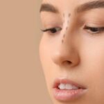 مزوتراپی بینی چیست | ماندگاری و عوارض | عکس قبل و بعد درمان 18 مزوتراپی بینی