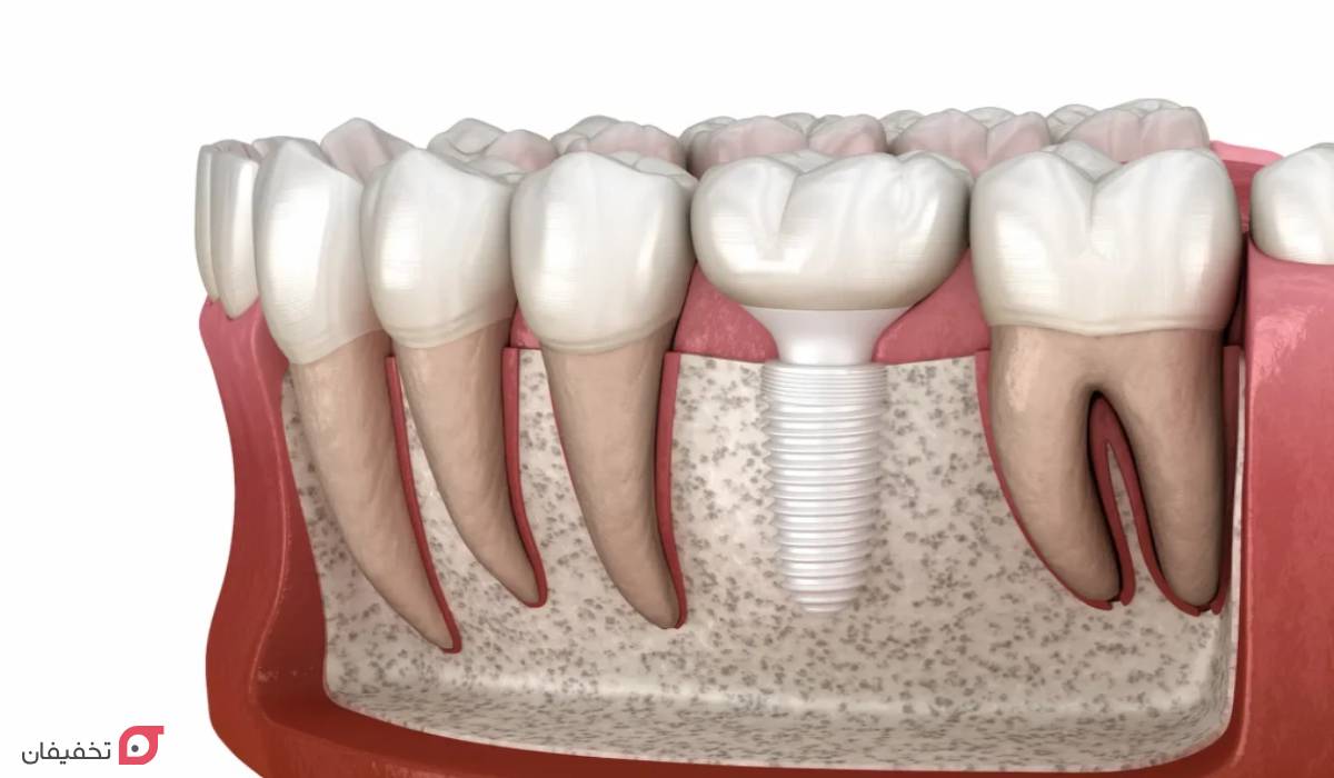 ایمپلنت دندان چیست | چند مرحله و روش دارد | چقدر طول می کشد 7 ایمپلنت دندان