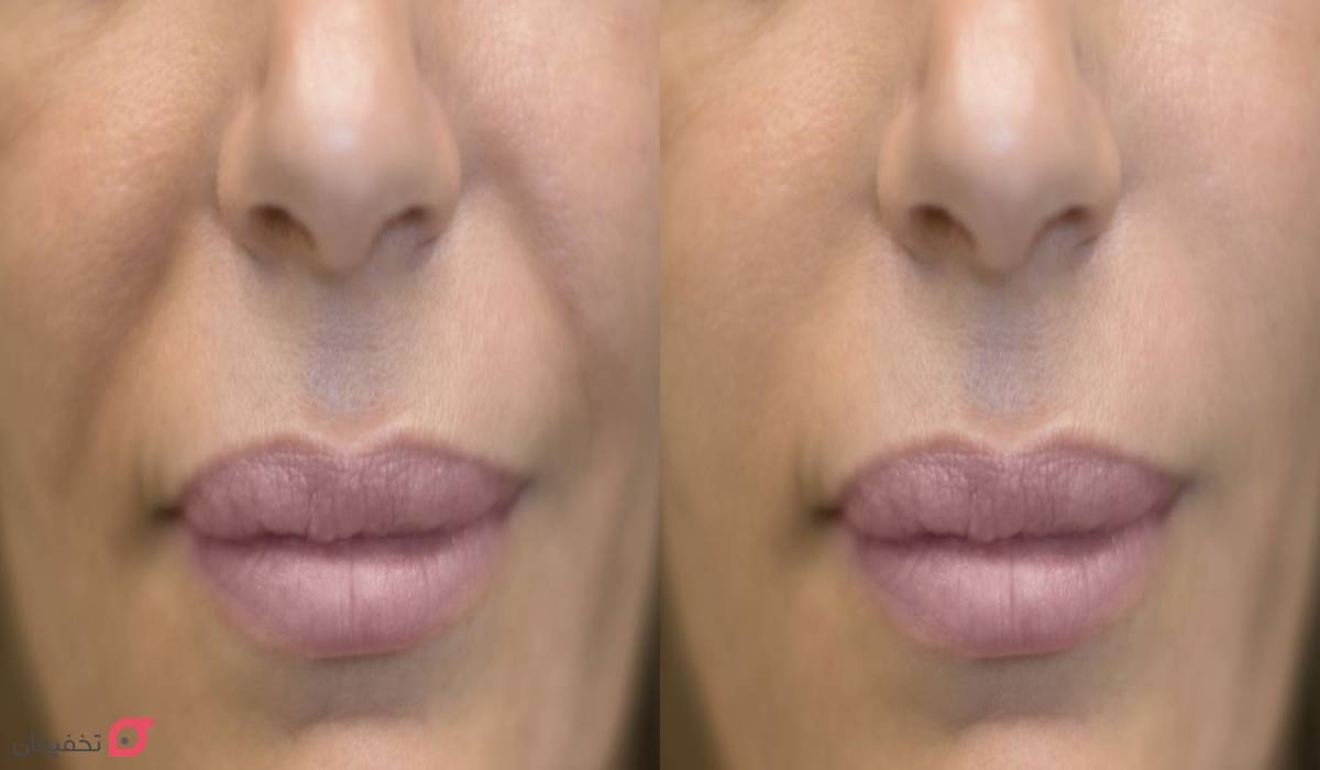 بوتاکس خط خنده چیست | نحوه تزریق و ماندگاری | عوارض + عکس 11 بوتاکس خط خنده