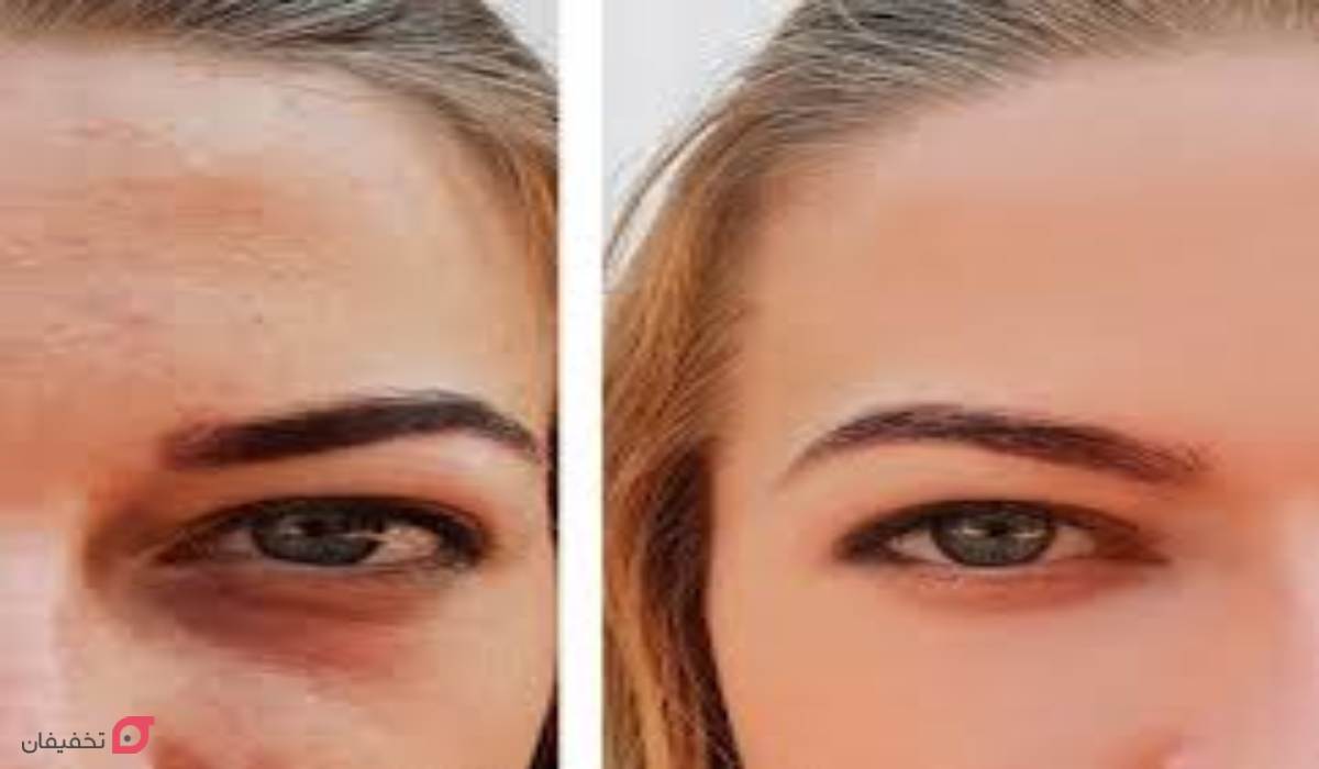 مزوتراپی زیر چشم | مزایا و عوارض | تعداد جلسات و ماندگاری 5 عکس مزوتراپی زیر چشم