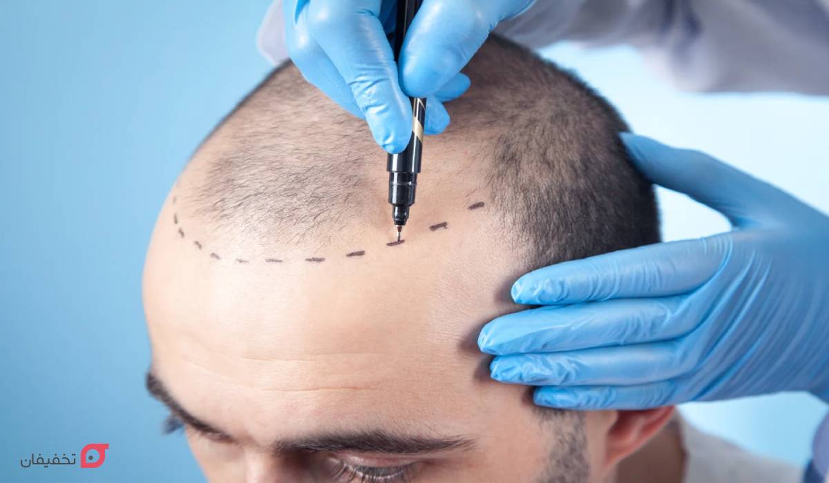 روش کاشت مو بدون جراحی چیست؟