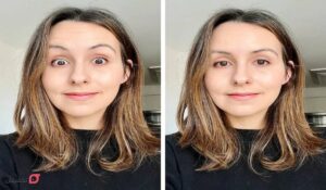 بوتاکس پیشانی چیست | ماندگاری | مراقب بعد از بوتاکس | عوارض