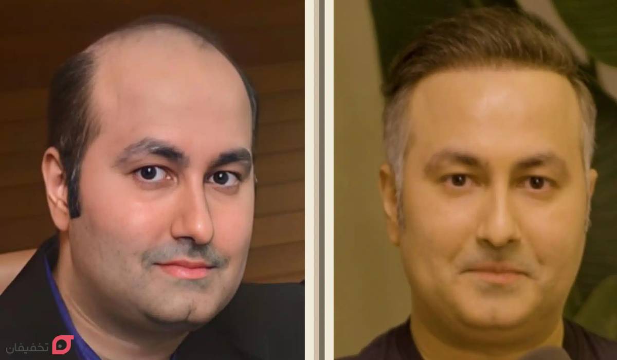 بهترین روش کاشت مو | جدیدترین روش بدون بانک مو، درد و جراحی 7 بهترین روش کاشت مو