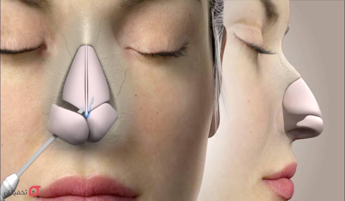 مراحل مزوتراپی بینی