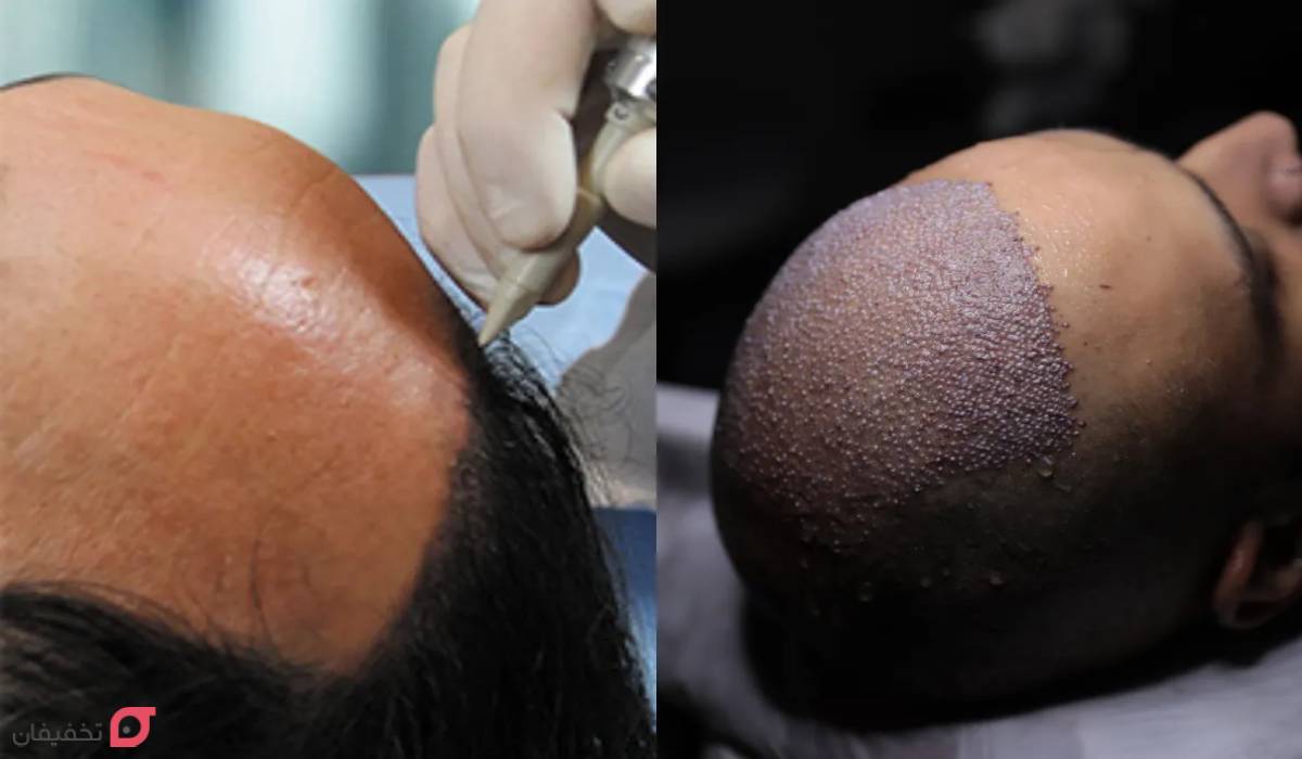 بهترین روش کاشت مو | جدیدترین روش بدون بانک مو، درد و جراحی 9 بهترین روش کاشت مو