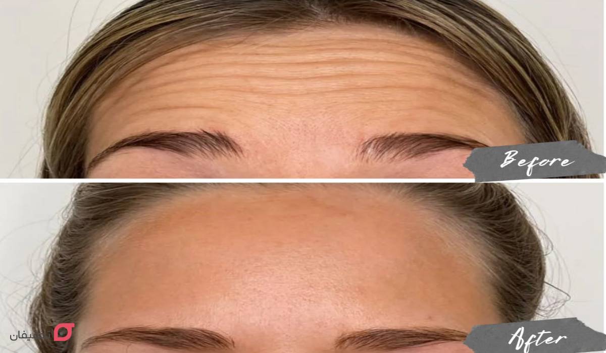 بوتاکس پیشانی چند جلسه است؟