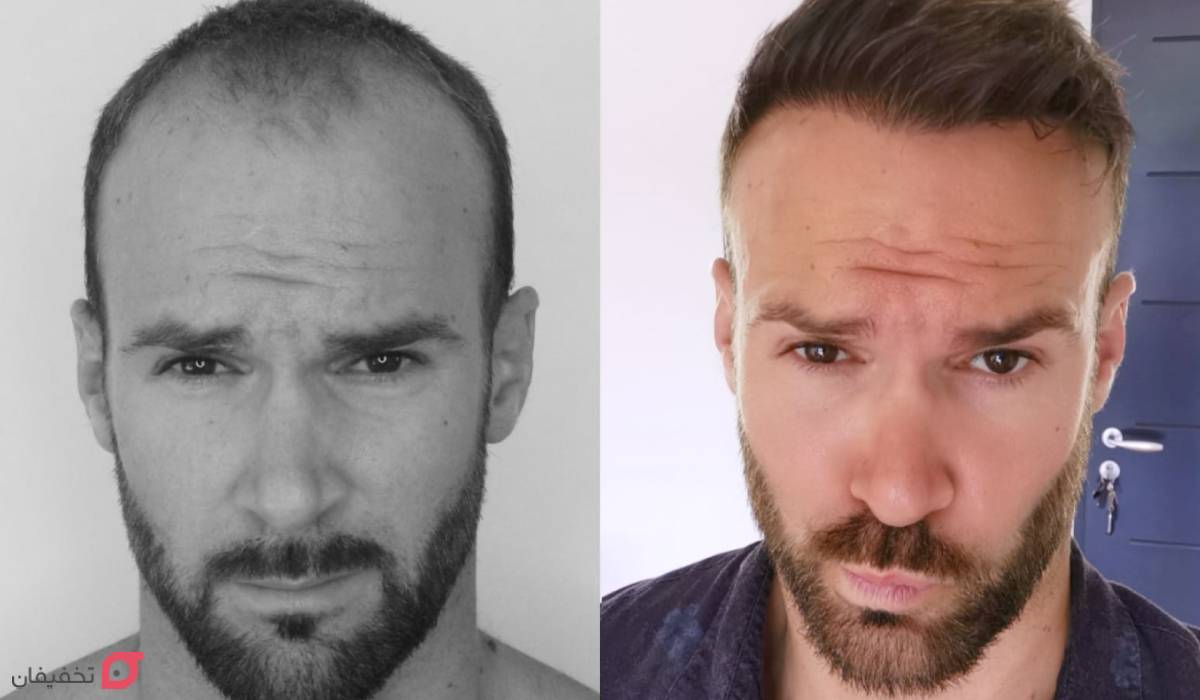 بهترین روش کاشت مو | جدیدترین روش بدون بانک مو، درد و جراحی 11 بهترین روش کاشت مو