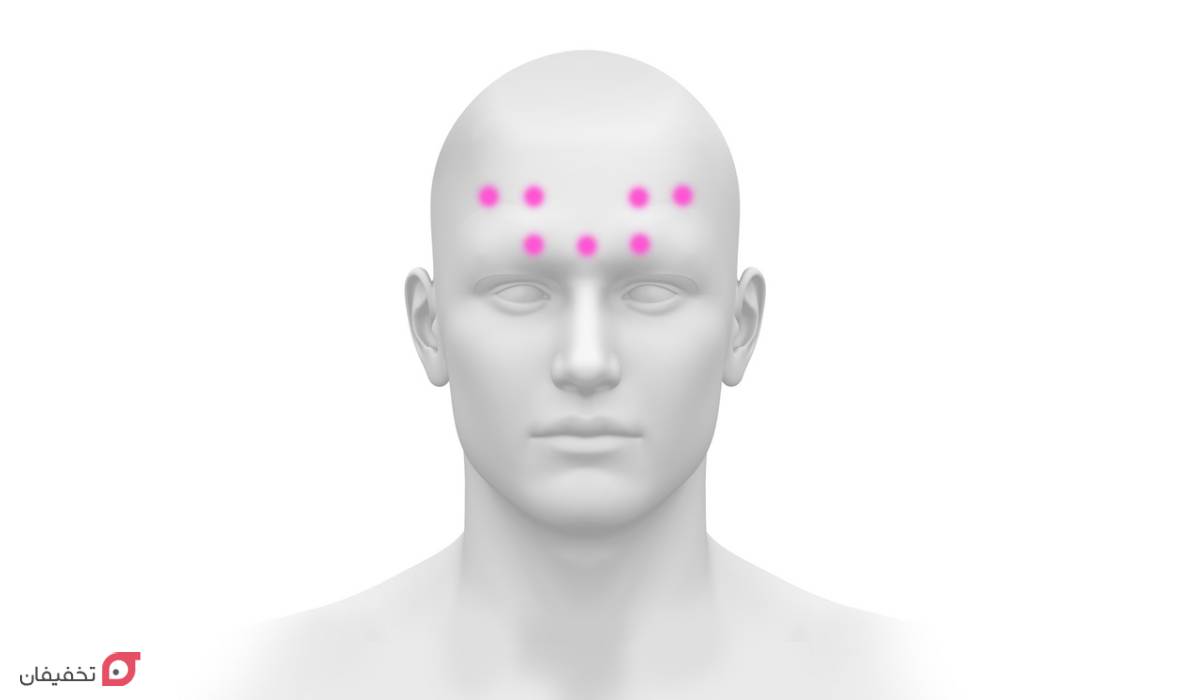 بوتاکس میگرن چیست | تاثیر برای سردرد | نقاط تزریق | ماندگاری 6 بوتاکس میگرن