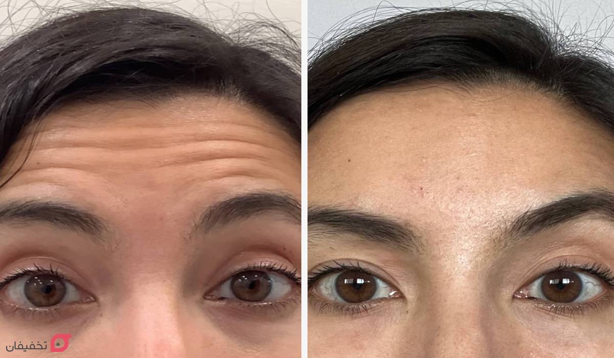 بوتاکس پیشانی چیست | ماندگاری | مراقب بعد از بوتاکس | عوارض 3 عکس قبل و بعد بوتاکس پیشانی