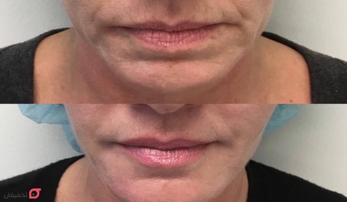 بوتاکس لب چیست | انواع مدل و ماندگاری | عوارض | هزینه + عکس 7 عکس قبل و بعد بوتاکس لب