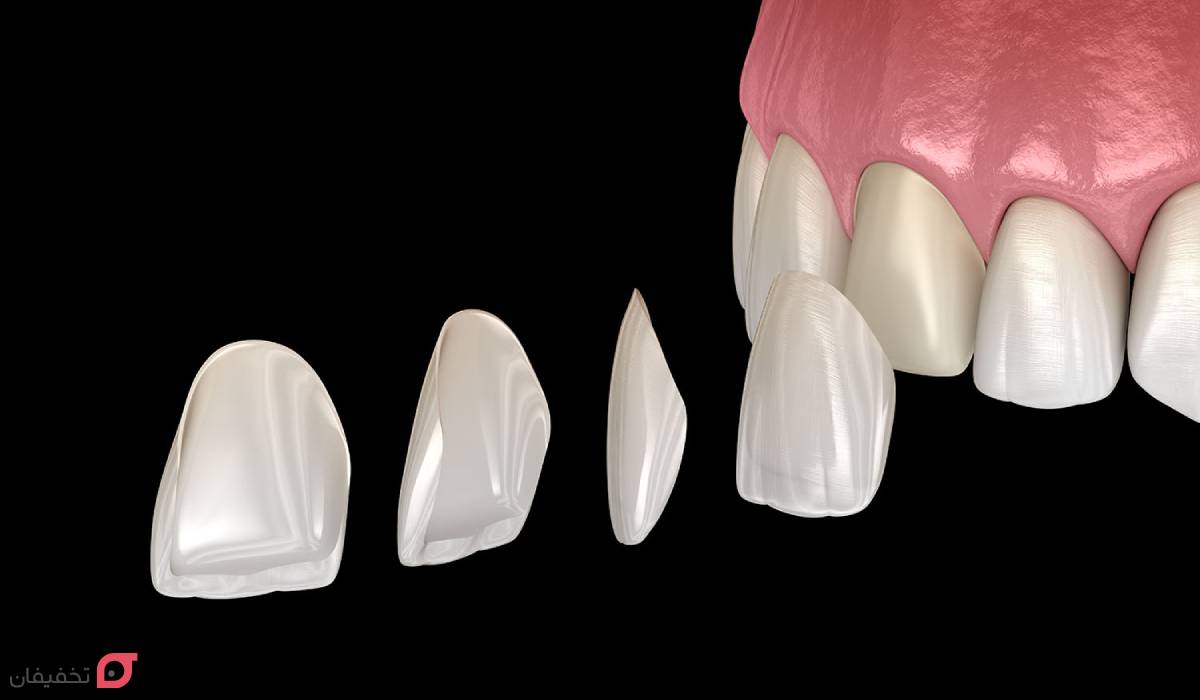 تفاوت لمینت و کامپوزیت چیست | بررسی 8 فرق اصلی با عکس 3 تفاوت لمینت و کامپوزیت