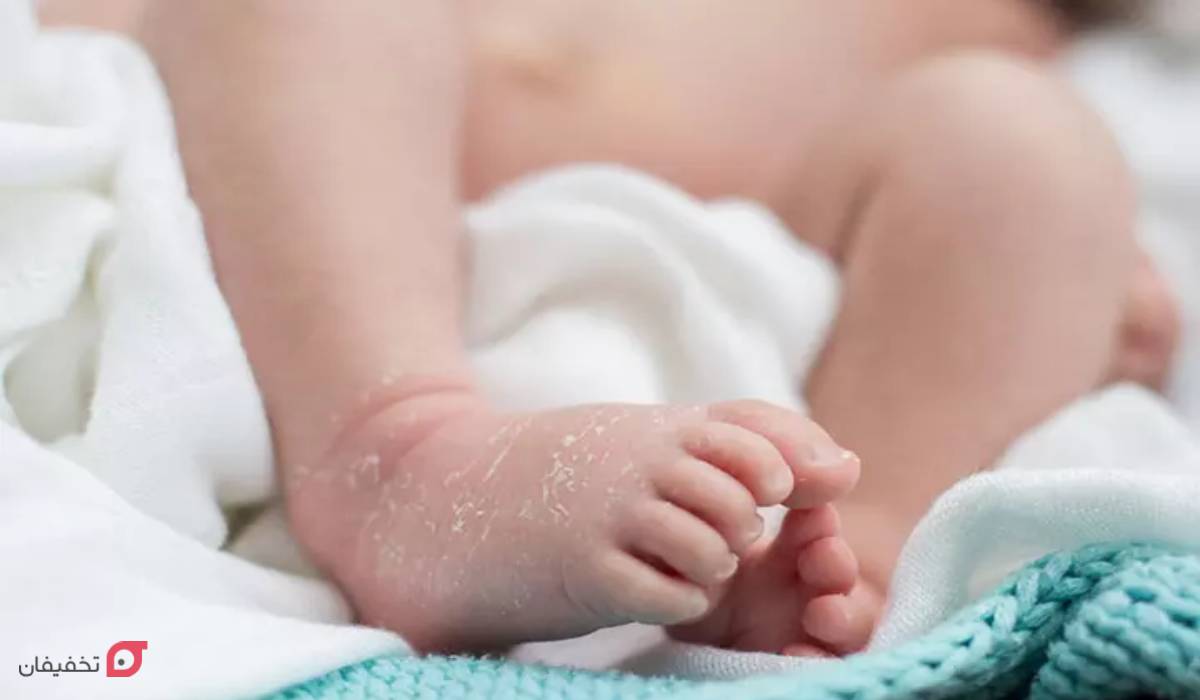 عوارض تیروئید کم کار در نوزادان