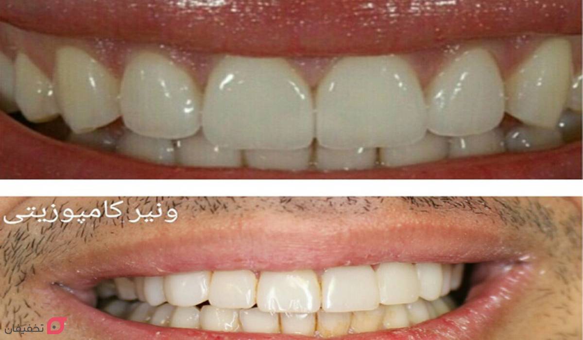 تفاوت لمینت و کامپوزیت چیست | بررسی 8 فرق اصلی با عکس 5 تفاوت لمینت و کامپوزیت