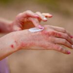 درمان خانگی اگزما | 9 درمان قطعی اگزمای شدید دست، لب و پا 31 درمان خانگی اگزما