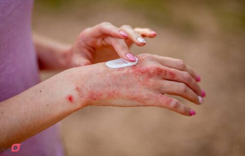 درمان خانگی اگزما | 9 درمان قطعی اگزمای شدید دست، لب و پا 14 درمان خانگی اگزما