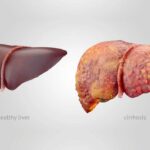 سیروز کبدی چیست | علائم اولیه | آیا سیروز درمان قطعی دارد؟ 33 سیروز کبدی