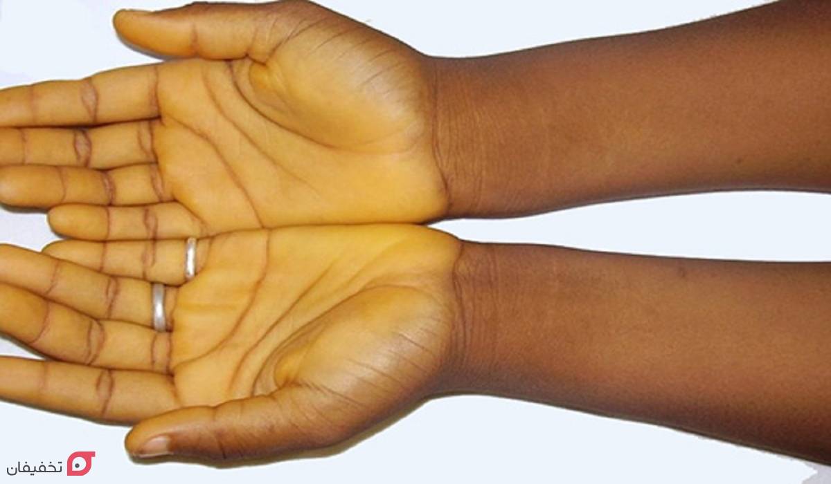 سیروز کبدی چیست | علائم اولیه | آیا سیروز درمان قطعی دارد؟ 3 علائم سیروز کبدی