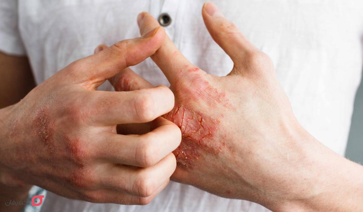 دلیل بیماری اگزما چیست؟