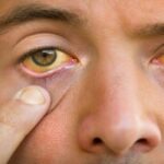 عوارض کبد چرب | عوارض گرید 1، 2، 3 و 4 روی پوست بدن و صورت 31 عوارض کبد چرب