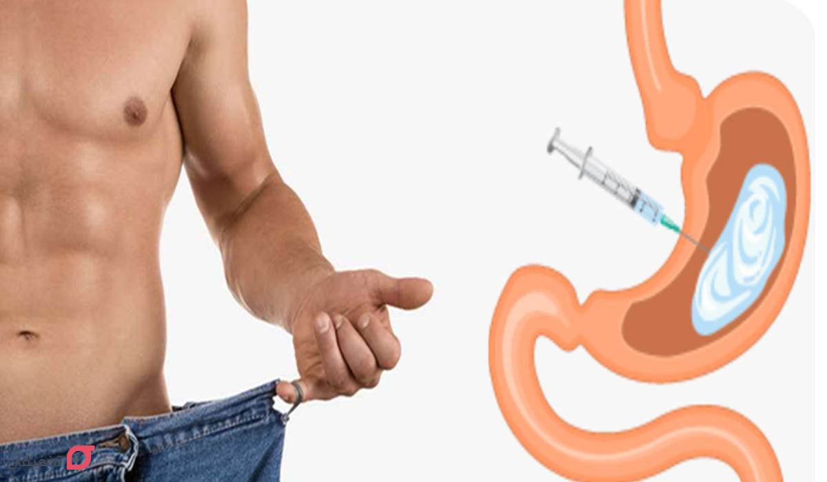 بوتاکس معده چیست | مراحل انجام برای لاغری | عوارض + هزینه 9 هزینه بوتاکس معد