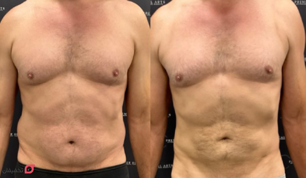 بوتاکس معده چیست | مراحل انجام برای لاغری | عوارض + هزینه 5 بوتاکس معده