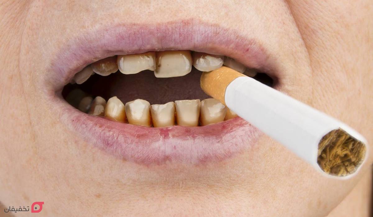 تا چند ساعت بعد از کامپوزیت نباید سیگار کشید؟